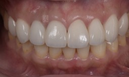 牙齒變色與假牙不一致、樹脂變色---全瓷冠貼片修復