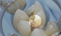牙齒咬起來酸酸的，不是蛀牙，而是牙齒裂了------全瓷嵌體修復