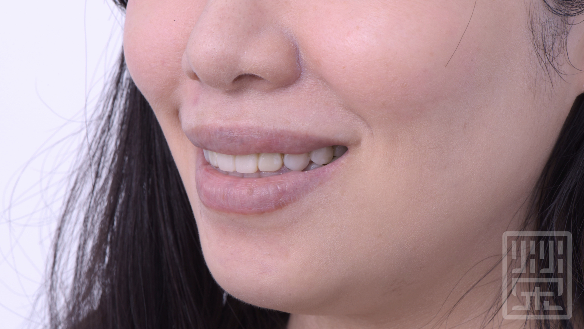 利用數位微笑模擬，將牙齒長度調整，符合微笑曲線