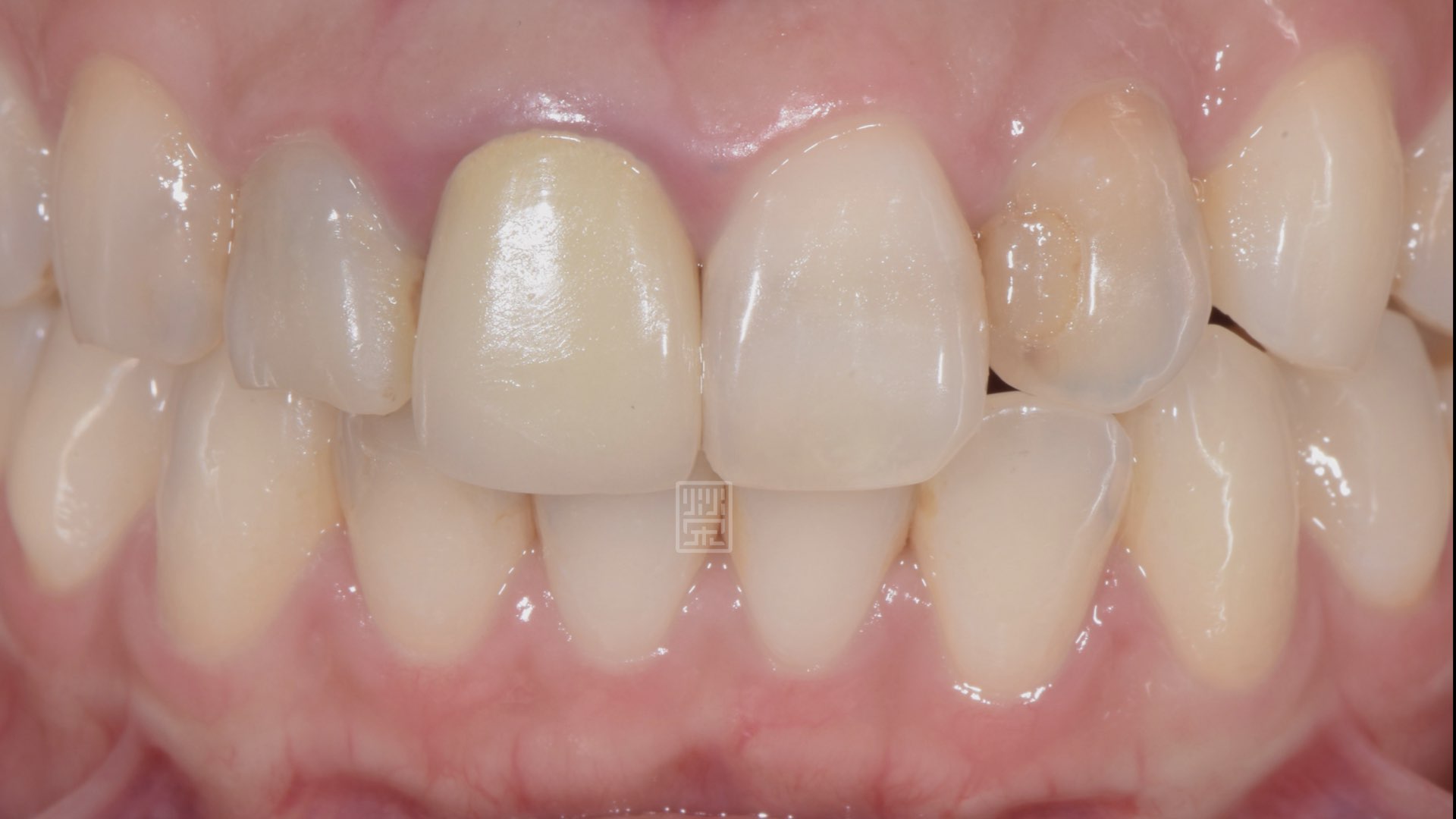 門牙舊假牙顏色不均,根管治療後牙齒變色