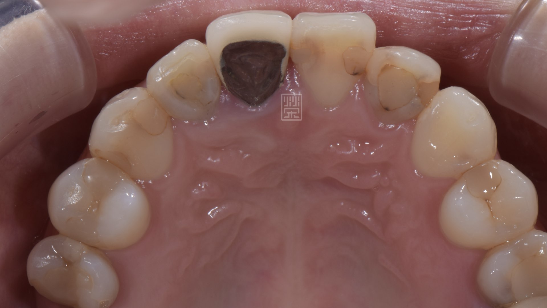 門牙舊假牙顏色不均,根管治療後牙齒變色