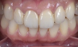 門牙舊假牙黑邊露出來，根管治療後的牙齒變色------全瓷冠貼片搭配修復