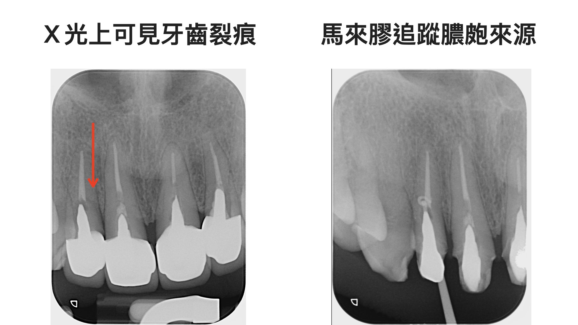 牙齒斷裂，Ｘ光檢查可發現斷裂面
