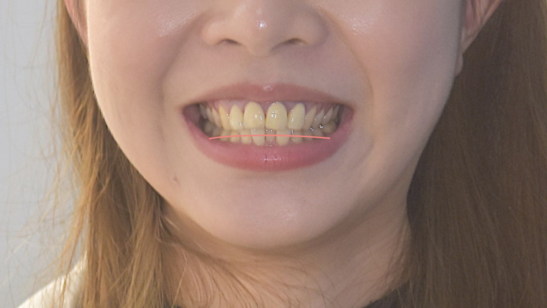 牙齒呈現反微笑曲線，呈現倒凹狀
