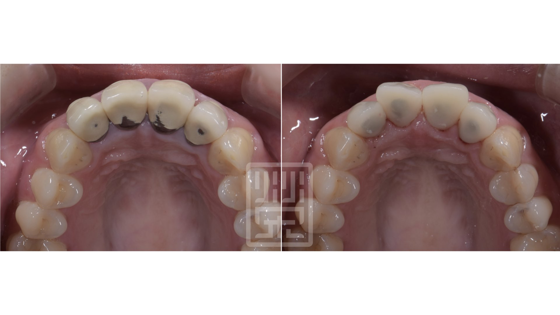 更換臨時假牙，並且模擬原先牙齒型態