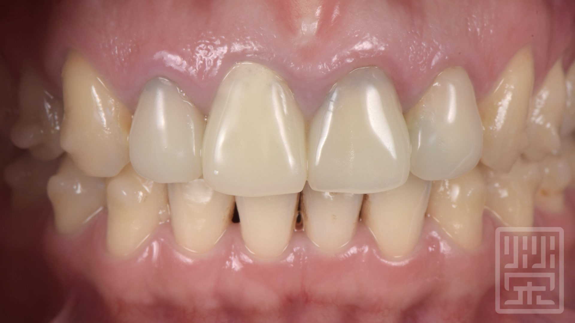 矯正結束後將牙齒排列至適當位置