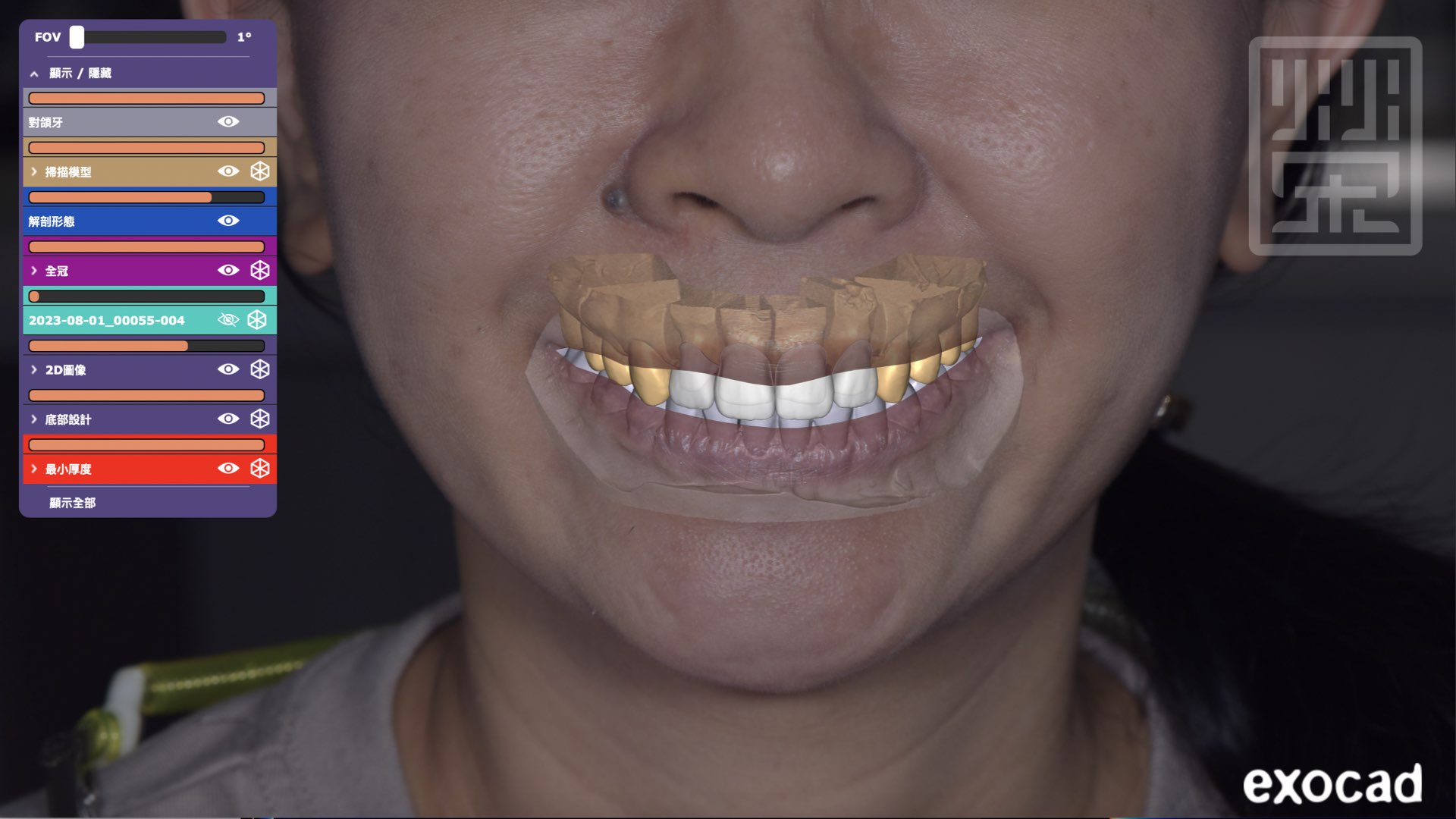 數位設計牙齒與臉型搭配