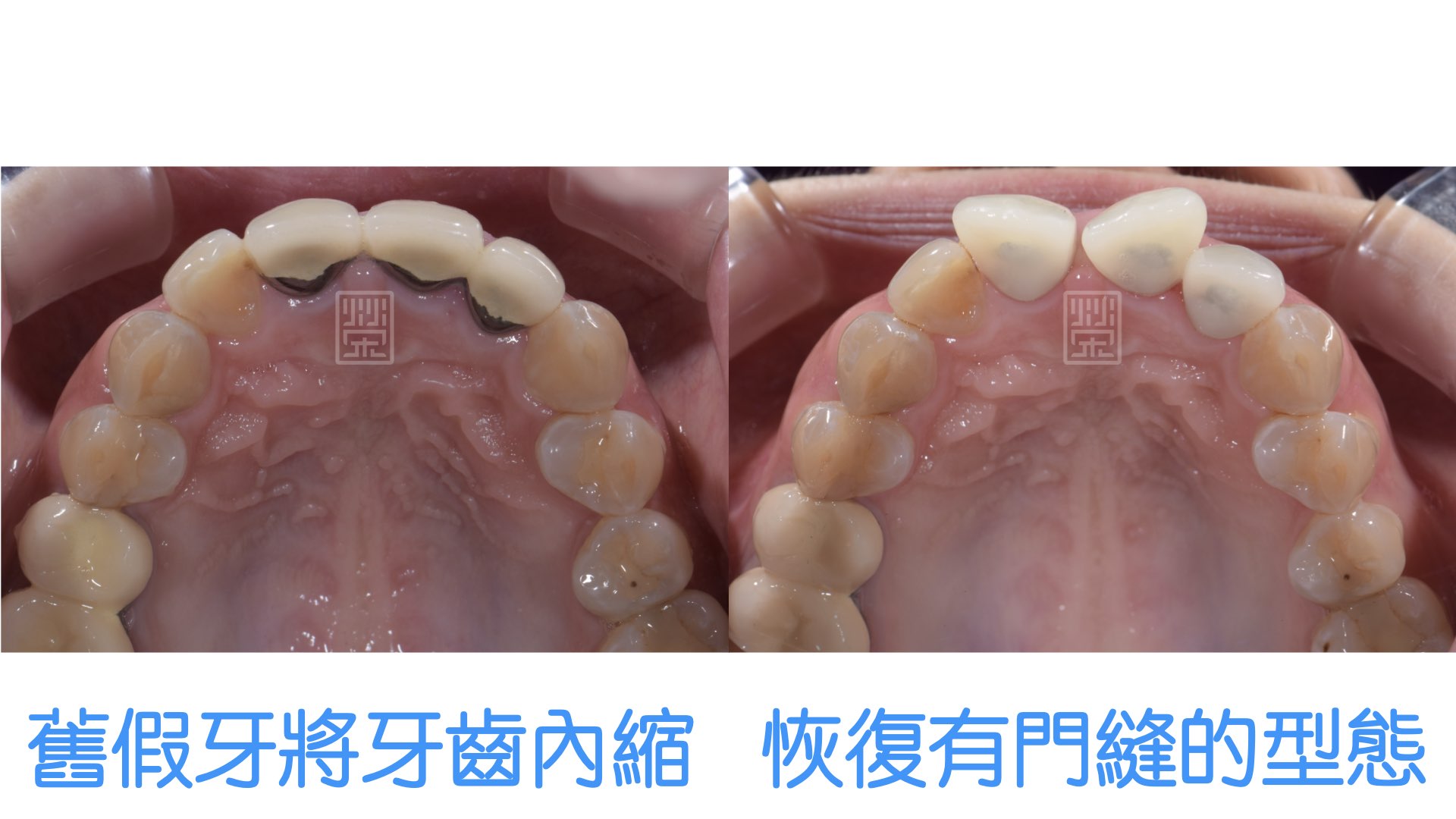 矯正前將舊假牙拆除，並且恢復以前牙齒的排列，以方便矯正醫師牙齒移動