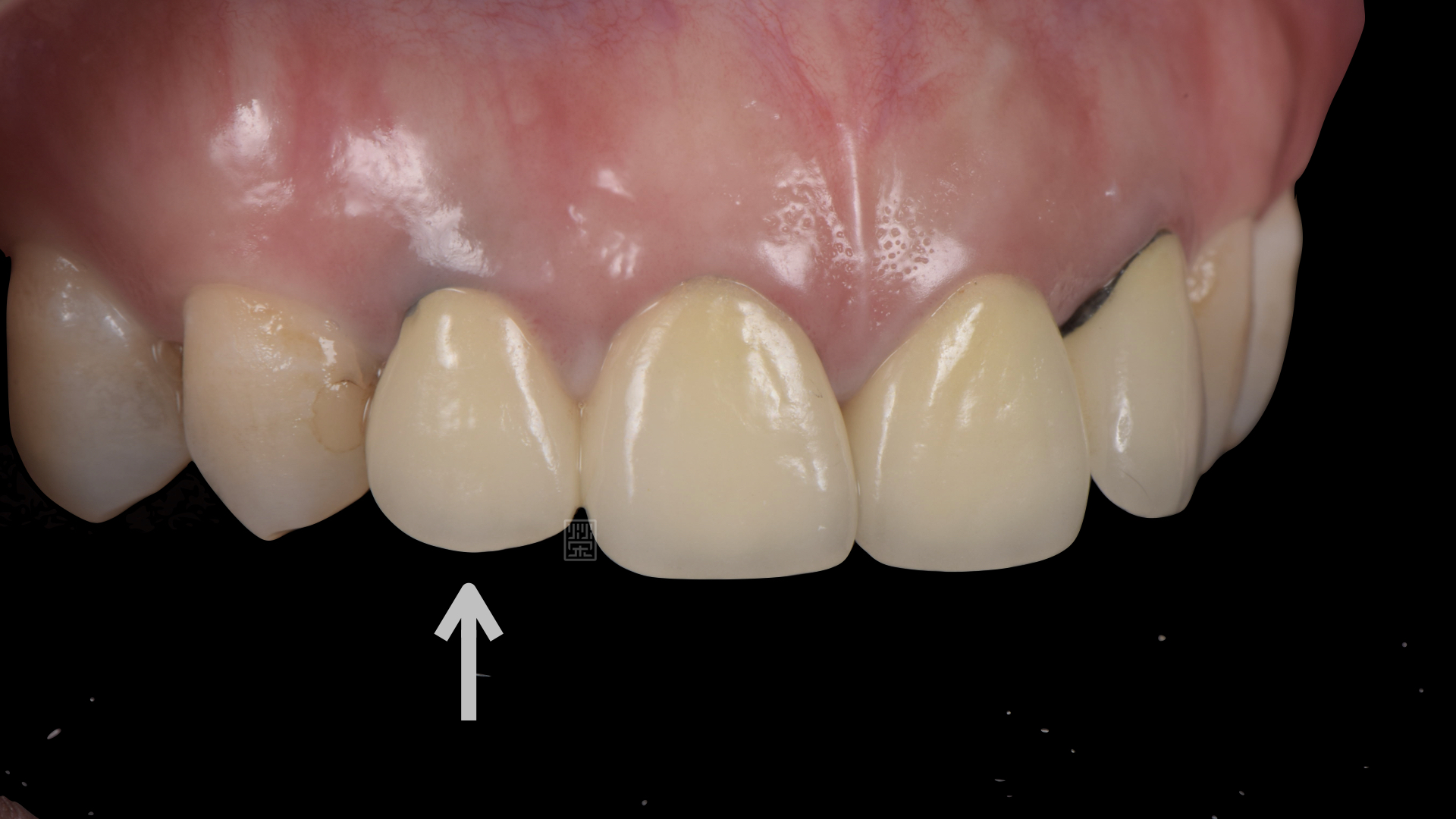 右側側門牙根黑影透出牙齦