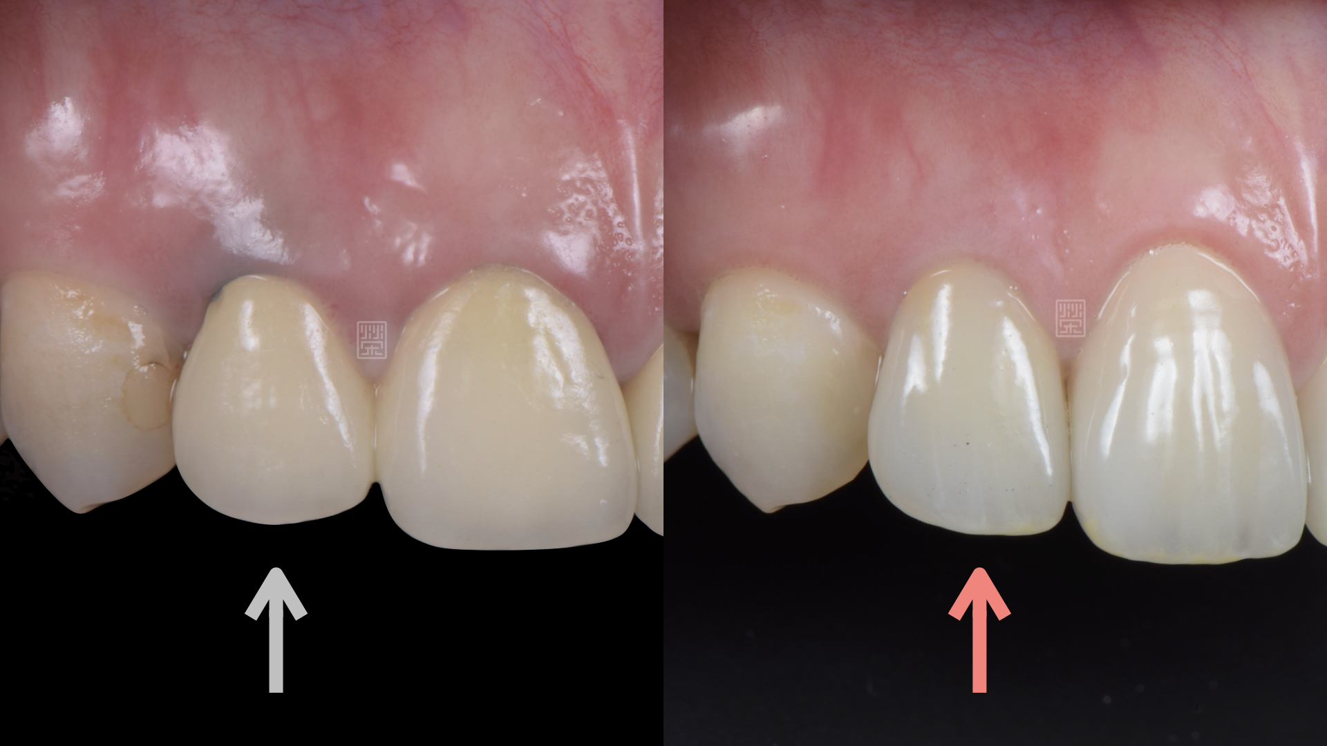 術前牙齦變黑，將全瓷冠邊緣深埋牙齦，將變色部分遮蓋